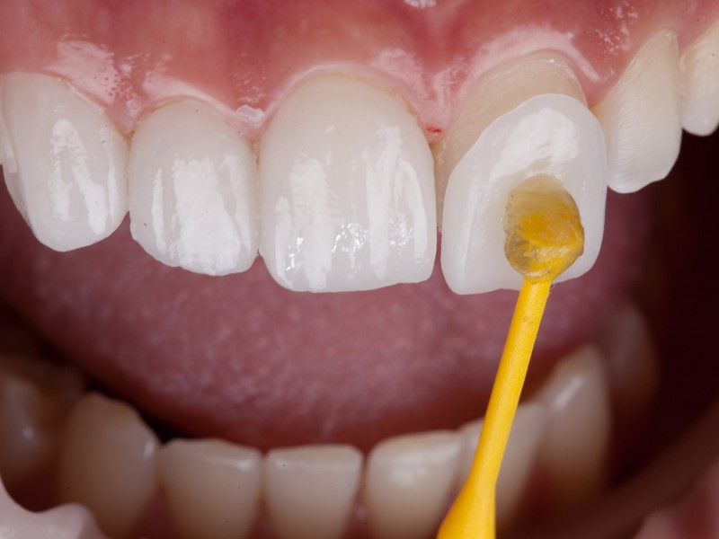 Navlake za zube su vrlo kvalitetne, jer je napredkom tehnologije došlo do novih materiala.